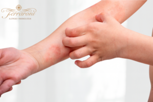 Lesões avermelhadas no braço, pessoa coçando a pele, representando sintomas de dermatite atópica.