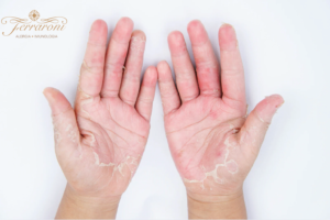Mulher com pele sensível na mão devido à dermatite de contato causada por cosméticos.