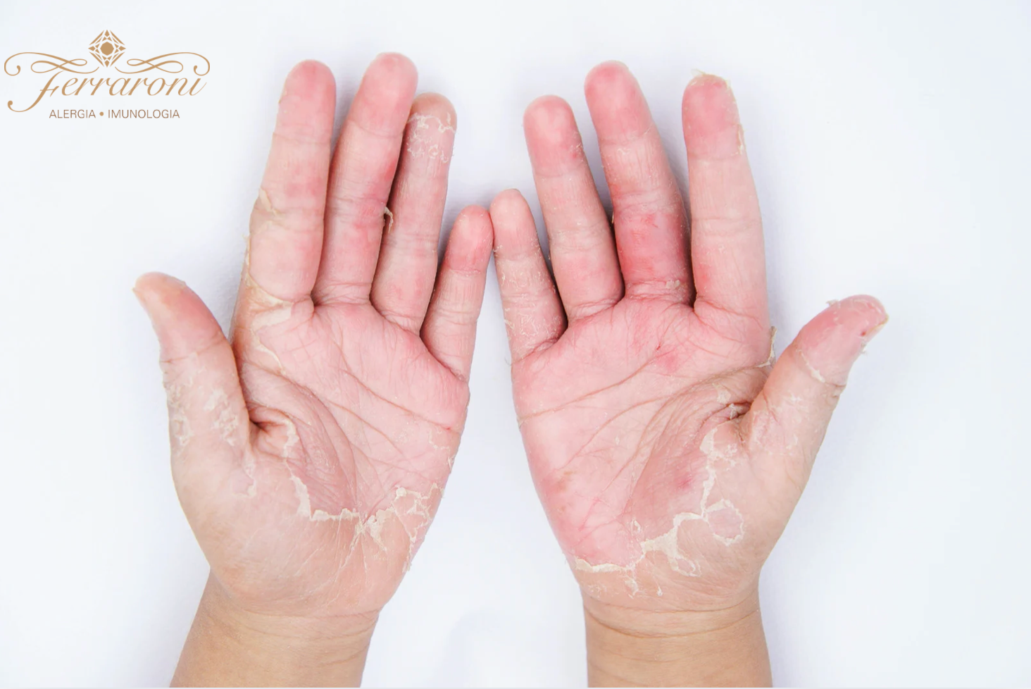 Mulher com pele sensível na mão devido à dermatite de contato causada por cosméticos.