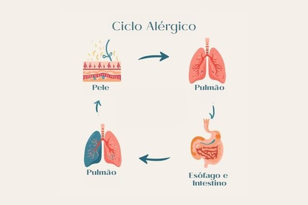 Representação gráfica da marcha alérgica, destacando a relação entre dermatite atópica, rinite, asma e alergias alimentares.
