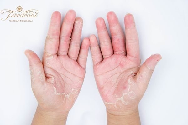 Mulher com pele sensível no rosto devido à dermatite de contato causada por cosméticos.